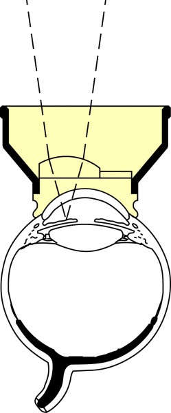 Ocular Abraham Iridectomy YAG - Ocular Instruments